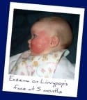 Eczema-Asthma-Irritability-