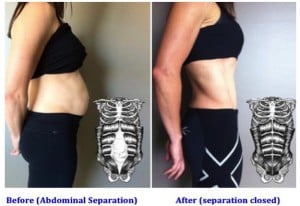 How To Know If You've Got Abdominal Separation - Mouths of Mums