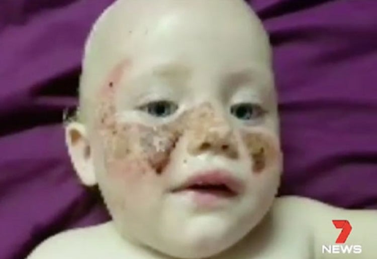 Yet another severe reaction to sunscreen sparks concerns Mouths of Mums